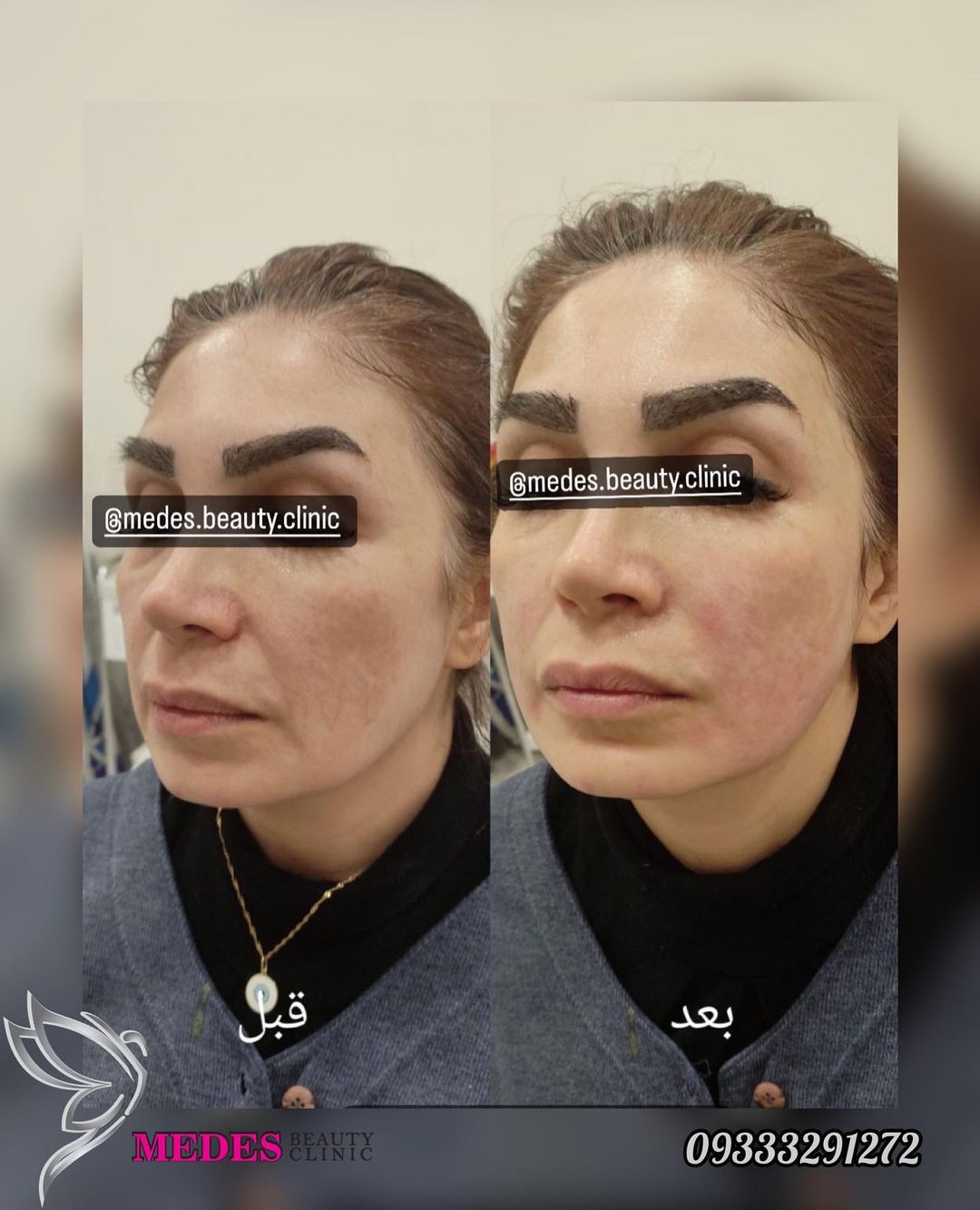 گالری هایفوتراپی